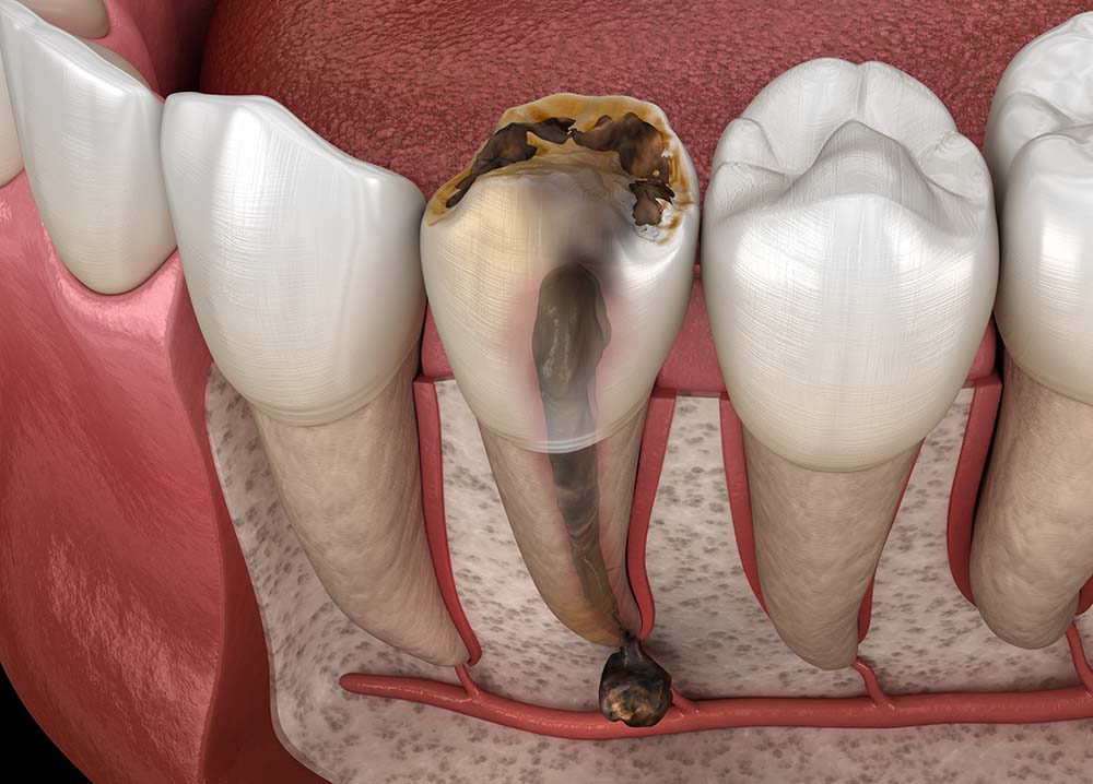 Плюсы профессионального удаления кисты зуба